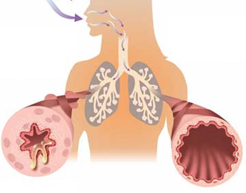 Hỏi chuyên gia: Tìm cách điều trị  đúng COPD