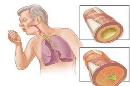 Các triệu chứng điển hình của lao phổi?