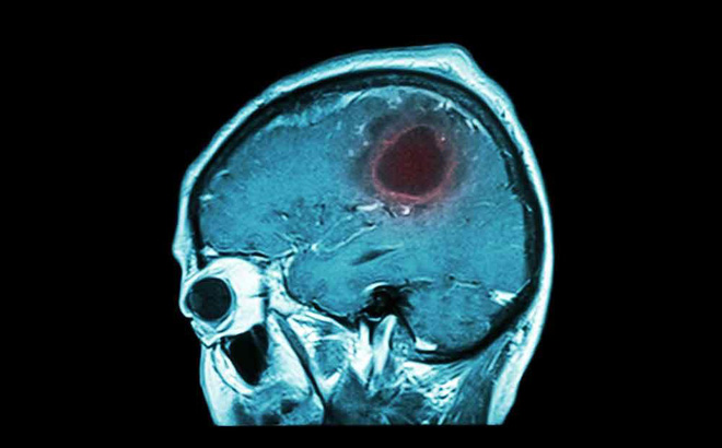 7 dấu hiệu bất thường cảnh báo bạn có thể đang có 1 khối u trong não