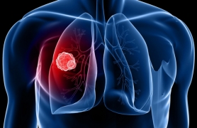 Ibuprofen có thể làm giảm nguy cơ tử vong do ung thư phổi