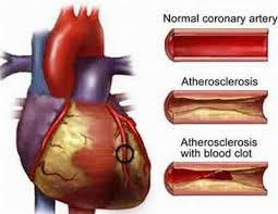 Có những yếu tố nguy cơ bệnh động mạch vành này, hãy gặp bác sỹ...
