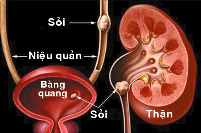 6 dấu hiệu cảnh báo sớm rối loạn chức năng thận ai cũng nên thuộc lòng - Ảnh 2.