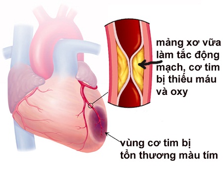 Sau nhồi máu cơ tim: Dùng thuốc thế nào để tránh biến cố?