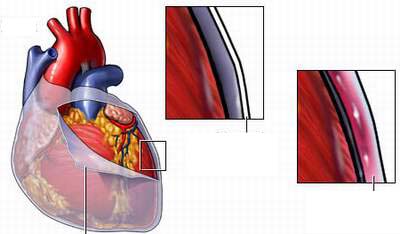 Vì sao bị viêm màng ngoài tim co thắt?