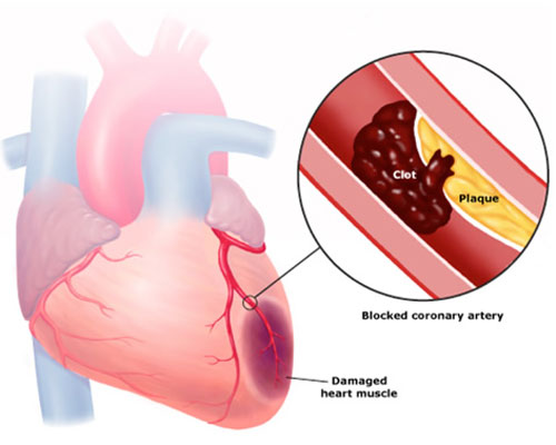 3 dấu hiệu cảnh báo cơn nhồi máu cơ tim đang đến gần