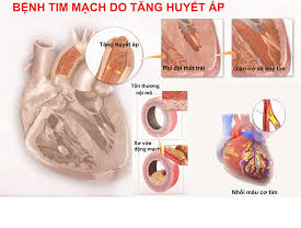 Hút thuốc - Nguy cơ tăng huyết áp và bệnh lý tim mạch