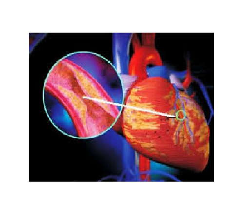 Tái cấu trúc tim sau nhồi máu cơ tim nguy hiểm thế nào? 
