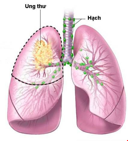 Nếu sợ ung thư phổi, hãy biết tránh 6 