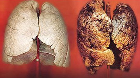 Gần 20 nghìn người chết mỗi năm vì ung thư phổi