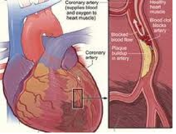 Bệnh động mạch vành và nguy cơ nhồi máu cơ tim - Phần 1 
