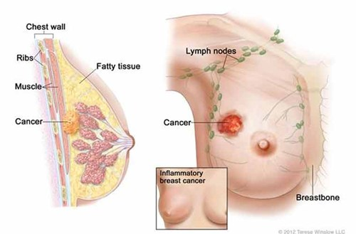5 điều cực đơn giản giúp bạn cắt giảm rủi ro mắc bệnh ung thư vú.